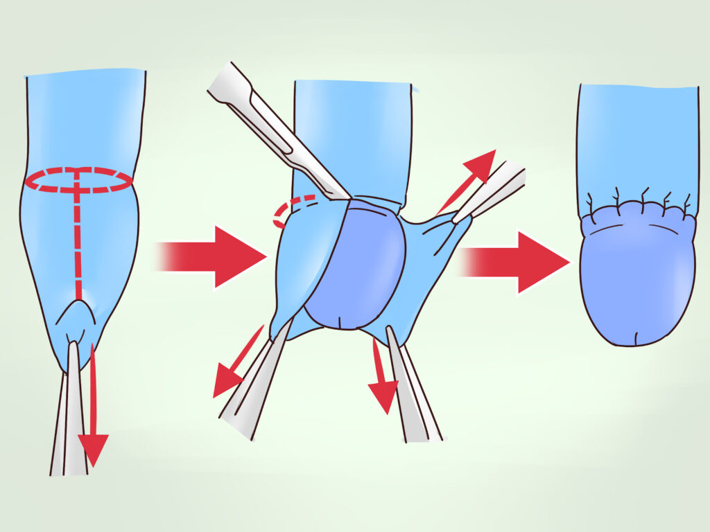 Postectomia - Cirurgia de Fimose