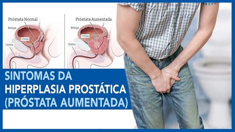 Sintomas Urinários da Hiperplasia de Próstata