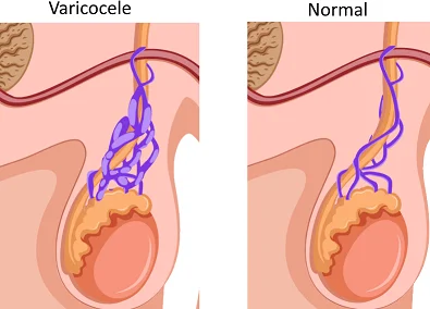 Varicocele