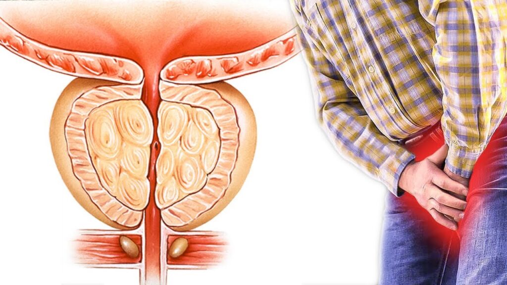 Sintomas de próstata